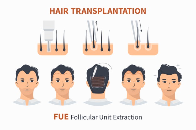 hair transplantation FUE