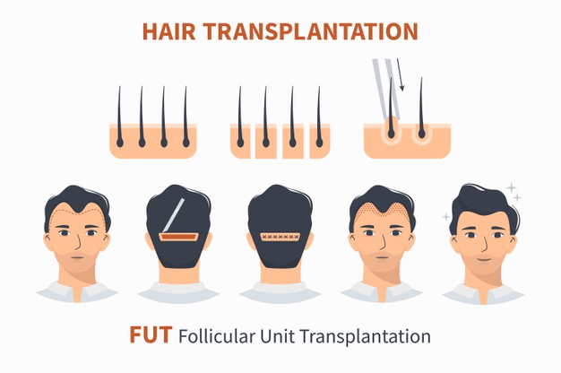 hair transplantation FUT
